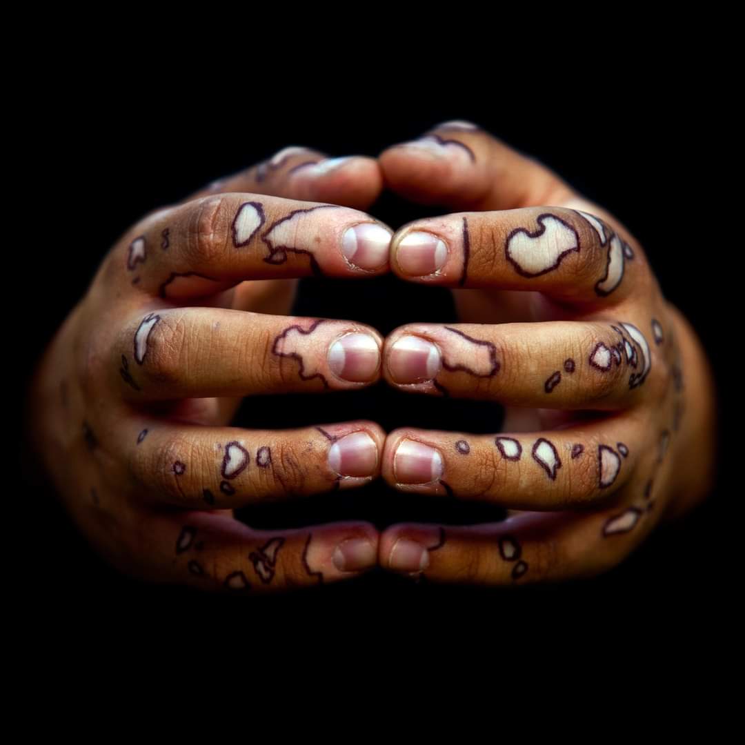 hands, manos, mano, bastian cifuentes araya, periodistafurioso, vitiligo,, Bastián Cifuentes Araya