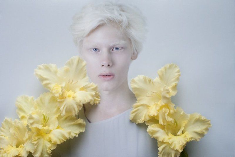 albinismphoto preview
